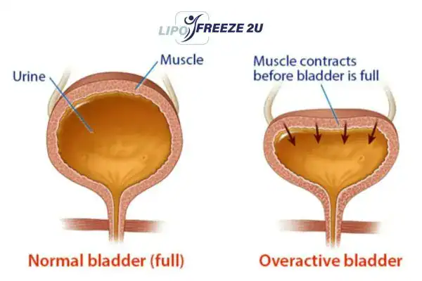 diagram of overactive bladder treatment Minehead
