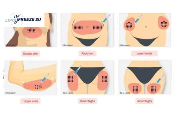 Benefits of Choosing Aqualyx for Fat Reduction Minehead