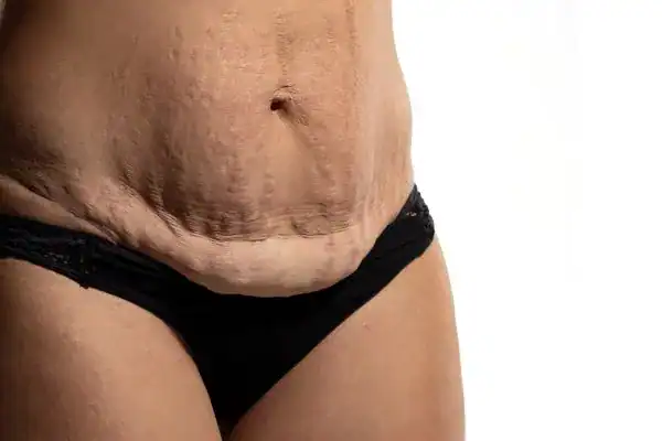 loose skin after weight loss injections Minehead