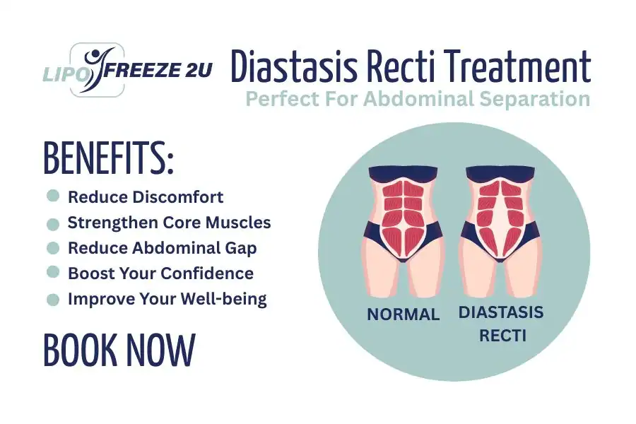 How Long Will It Take to See Improvements in Diastasis Recti Minehead