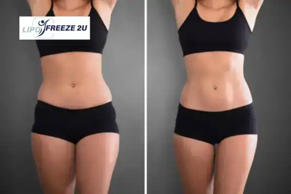 How Can LIPO FREEZE 2U Support Your Post-Pregnancy Body Recovery Minehead?