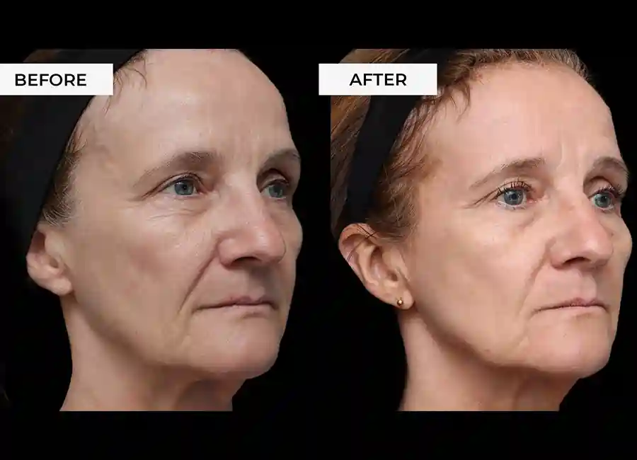 How Many RF Microneedling Sessions Will You Need to See a Difference Minehead?