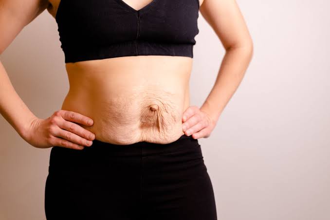 Is Surgery Really the Only Way to Repair Diastasis Recti Minehead?