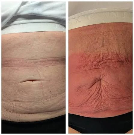 How Does RF Microneedling Improve Crepey, Thin and Uneven Skin Texture Minehead?