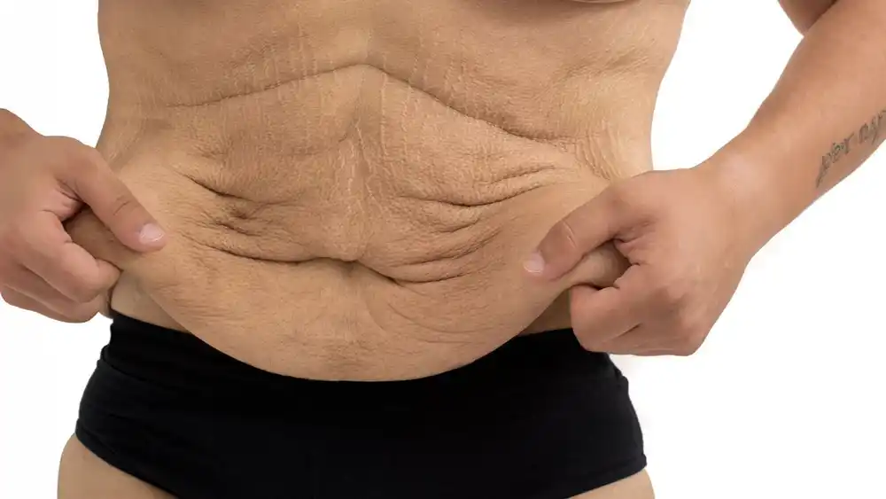 RF Microneedling for Loose Skin: How Can It Help Tighten and Reshape the Skin Minehead?